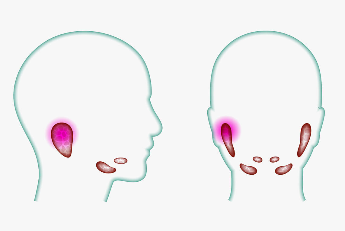 Tratamento de Câncer na Glândula Salivar  Cirurgia